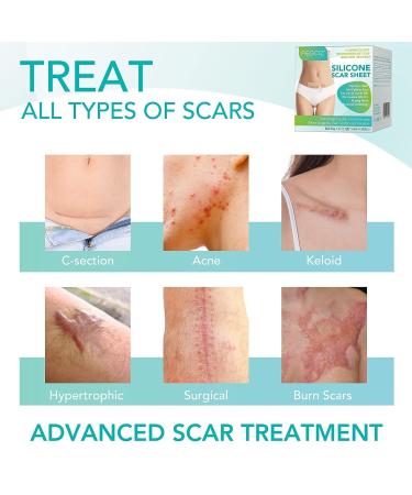 Silicone Scar Sheets - Professional Scar Removal Tape for C-Section, Surgery, Burn, Keloid, Acne - Soften and Flatten Scars - 1.6 x 120 - 3M Roll - Buy Online on GoSupps.com