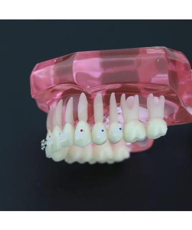 Buy Dental Orthodontic Teeth Model with Metal & Ceramic Brackets - Ideal for Study & Research | International Shipping Available - Buy Online on GoSupps.com