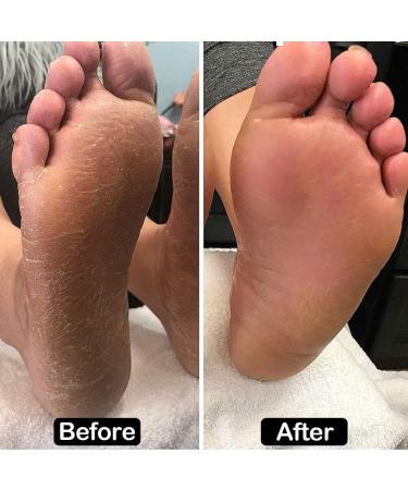 Handheld Callus Remover Pedicure Foot File Pedicure Tools Foot Grinder Foot Dead Skin Remover for Men Women Hard Dry Skin Heel Scrubber - Buy Online on GoSupps.com