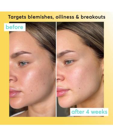 Super Facialist On The Spot Clarifying Gel - Spot Treatment for Acne with 10% Niacinamide Tea Tree Oil & Prebiotics Vegan Friendly 15ml - Buy Online on GoSupps.com