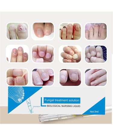 Okita Lot de 5 stylos anti-champignons pour ongles d'orteils - Buy Online on GoSupps.com
