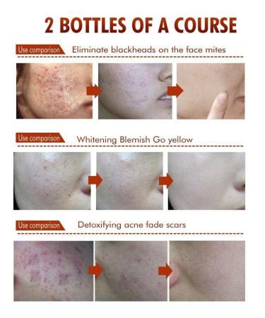 BIOAQUA Acne Scar Gel - Natural Blemish & Pimple Removal Cream for Oil Control & Pore Shrinking | International Shipping - Buy Online on GoSupps.com