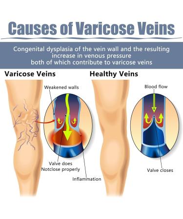 Jawfait 36PCS Varicose Veins Patch - Natural Relief Treatment for Legs Spider Varicose Vein Strengthen Capillary Health and Improve Blood Circulation - Buy Online on GoSupps.com