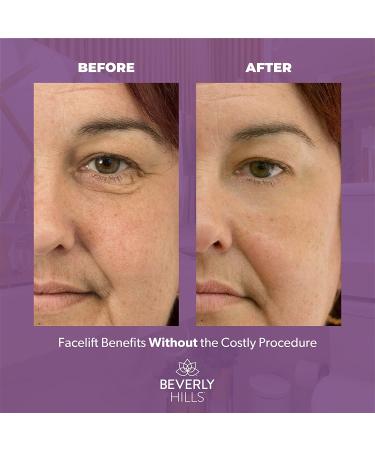 Beverly Hills V-Lift Instant Eye Lift & Eye Tuck Bee Venom Serum | Puffy Eyes, Dark Circles, Wrinkles, Under Eye Bags Treatment | 30mL (120 Day Supply) - Buy Online on GoSupps.com