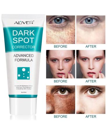 Dark Spot Corrector & Remover | Fade Black Precipitate, Remove Freckles | Dark Spot Correcting Cream - Buy Online on GoSupps.com
