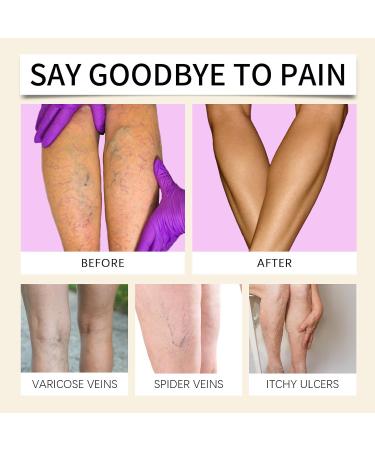 Baume Miracle Pour Les Veines Baume base de plantes 2pc cr me conjointe apaisante Cr me apaisante pour le dos jambes les articulations pieds et le corps Am liore Varices R duit Les Gonflements - Buy Online on GoSupps.com