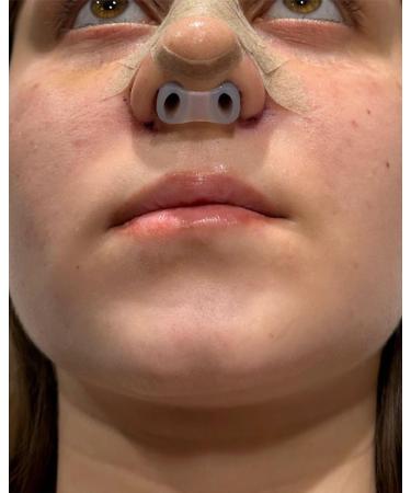 Nostril Retainer Short Model | Nostril Retainer Rhinoplasty | Nasal Retainer Rhinoplasty & Nose Splint for Rhinoplasty Recovery | 100% High Grade Silicone | Nostril Retainer Size (6) - Buy Online on GoSupps.com