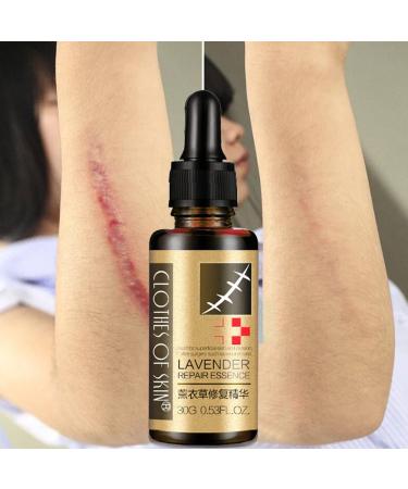 Hotiary Scar Removal Serum - Lavender Repair Essence 30g (1 Pack) - Skin Repair for Cuts, Stretch Marks, Burns & Postoperative Scars - Buy Online on GoSupps.com