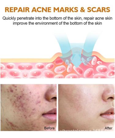  Eastuy Pore Minimizer - 18ml Pore Tightening Oil with Extracts of - Pimple Remover Based Pore Control Essential Essence Brightening Oils Eastuy - Buy Online on GoSupps.com