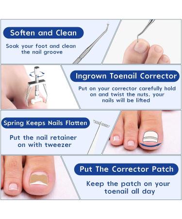 Professional Ingrown Toenail Treatment Kit - Includes Toenail Corrector, Tweezer, Strips, Braces, and Patches - Buy Online on GoSupps.com