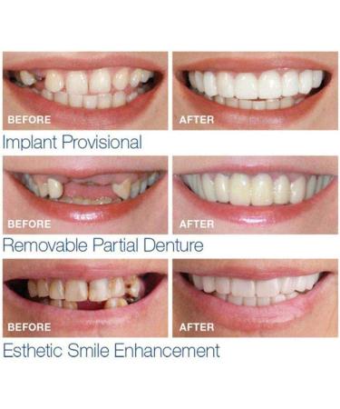 BGZ 4-Piece Cosmetic Teeth Veneers - Instant Perfect Smile | Temporary Fake Teeth for Men & Women | Cover Broken & Missing Teeth - Buy Online on GoSupps.com