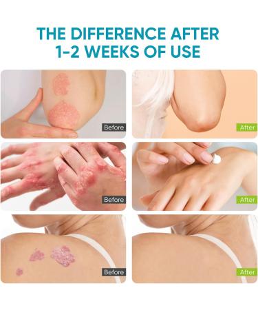 iTecFreely Psoriasis Cream: Fast & Effective Scalp Treatment for Dry Scalp, Dandruff & Eczema - Face and Body Relief - Buy Online on GoSupps.com