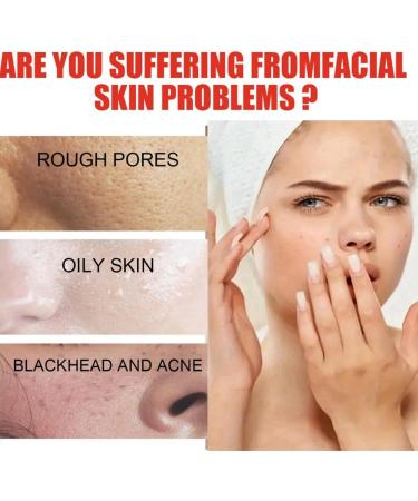 Aze-laic Acid Suspension 10% Face Serum Aze-laic Acid Face Cream Hyperpigmentation Treatment Niacinamide Cream Hydrating Face Cream Brightening Face Cream Face Skin Care Beauty With Niacinamide30ML - Buy Online on GoSupps.com