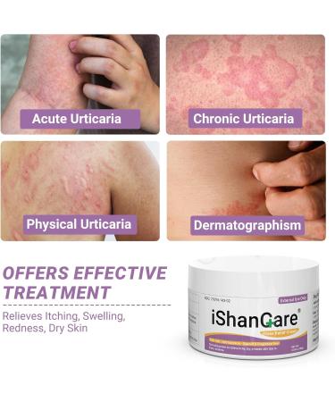 Urticaria Cream - Fast Relief for Hives Allergic Rashes & Itchy Skin | All-Natural Herbal Formula - 3.53 Oz - Buy Online on GoSupps.com