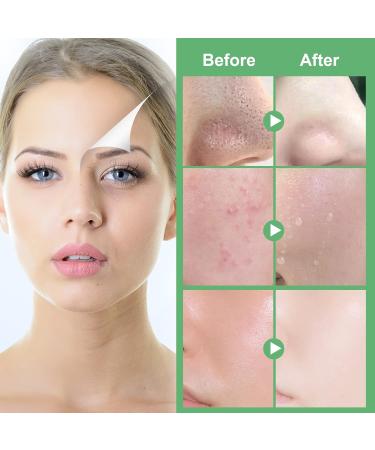 OEWWEX Green Tea Clay Stick & Pore Strips Combo Pack - 10 PC Blackhead & Acne Remover Patches for Deep Pore Cleansing - Men and Women's Skin Care - Buy Online on GoSupps.com