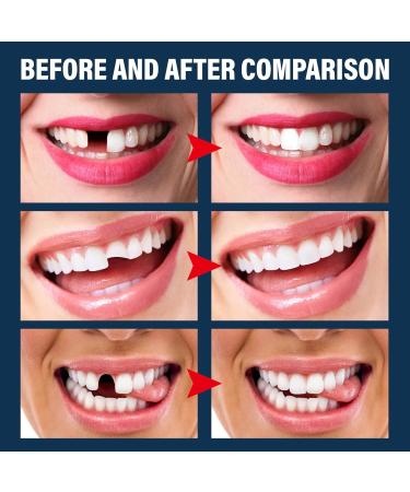 Provisional Denture Adhesive Set | DIY Temporary Tooth Repair Kit | Formable Dental Prosthesis Tools for Instant Fixes - Buy Online on GoSupps.com