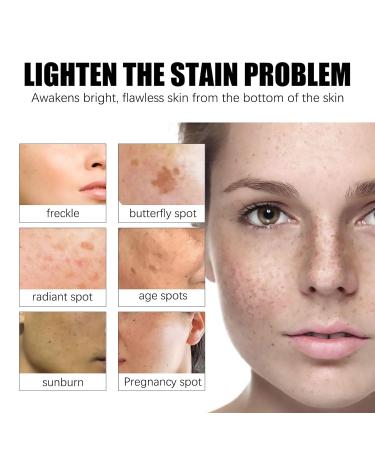 G neric Crema Para Manchas Oscuras En La Cara 30ml Crema Para Las Manchas De La Cara 1pcs Para Piel Entrepierna Manchas Codos Piernas Zonas Rodillas Cuello - Buy Online on GoSupps.com