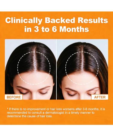 Pumpkin Seed Oil Gummies with Saw Palmetto Organic Pumpkin Seed Oil Supplement for Hair Growth Youthful Skin & Prostate Health with Omega 6 9 Sugar Free Cold Pressed Orange Flavor 60 Count 60 Count (Pack of 1) - Buy Online on GoSupps.com