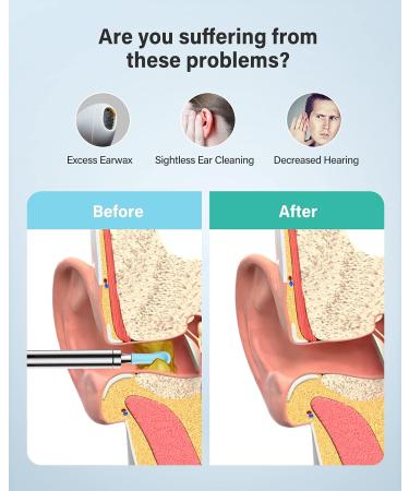 Xlife Ear Wax Removal Tool with 1080P Camera and Blackhead Remover - iPhone Compatible - Buy Online on GoSupps.com