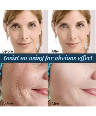 WZDYN Protein Line Hydrolyzed Collagen | Korean Soluble Protein Thread | Soluble Protein Thread Lifting Instant Face Protein Thread | Absorbable Collagen Thread for Face Lift | Reduce Fine Lines Wrinkle Firming Skin (5box/300pcs) - Buy Online on GoSupps.com