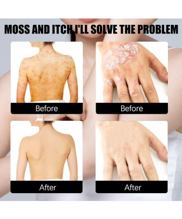 Meellop Herbal Psoriasis Relief Spray - Soothing Treatment for All Skin (3pcs) - Buy Online on GoSupps.com