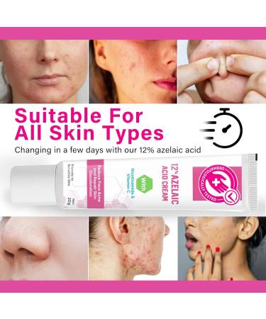 SCOBUTY Azelaic Acid Face Serum Cream Brightening Face Skin Care Treatment and Repair Dark Spots for All Skin Types 20ml 20 g (Pack of 1) - Buy Online on GoSupps.com