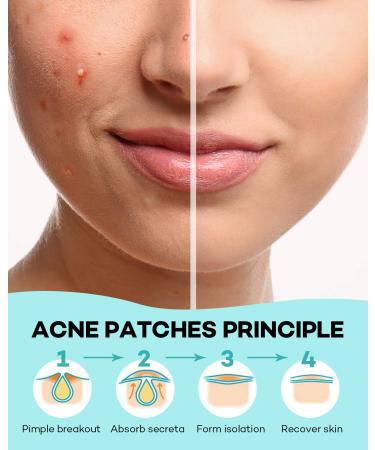 Acne Patch 140 Count Hydrocolloid Absorbing Cover Patch with Tea Tree & Calendula Oil - 4 Sizes Acne Dots for Face - 1 Pack - Buy Online on GoSupps.com