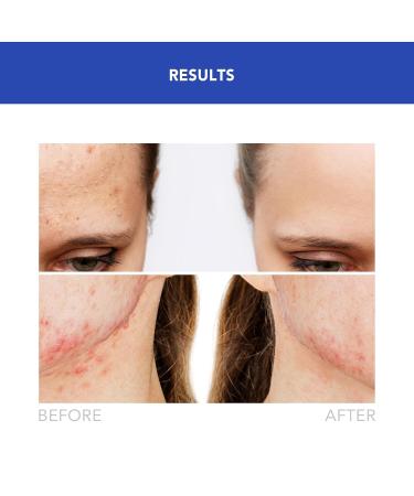 Buy Foreo ESPADA 2 LED Light Therapy - Medical-Grade Silicone Blemish Treatment Device for Scars & Pimples - International Shipping Available - Buy Online on GoSupps.com