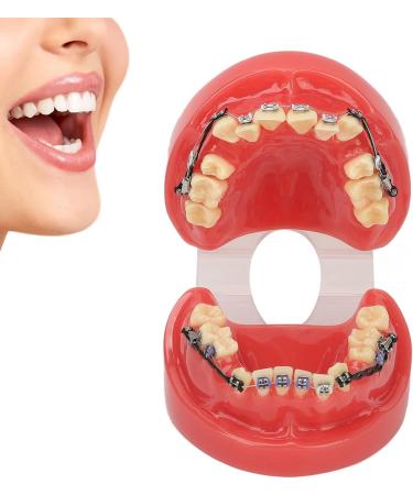Orthodontic Bracket Model - 24 Teeth Demonstration Model with Metal Wires & Brackets for Dental Education - Buy Online on GoSupps.com