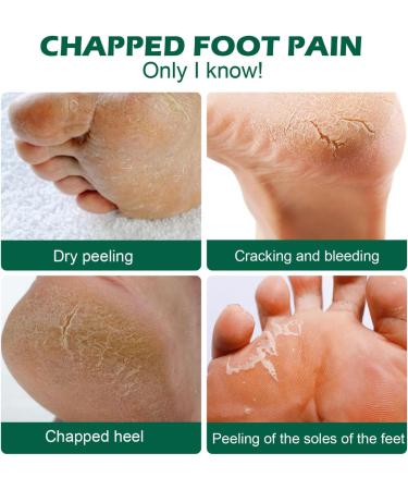 Urea Foot Cream Ultra Moisturizing 42% Urea Cream Heel Balm for Callus Removal and Soften Cracked Heel Repair Cream For Feet and Hand Maximum Strength for Hand Foot and Body Care - 100g - Buy Online on GoSupps.com
