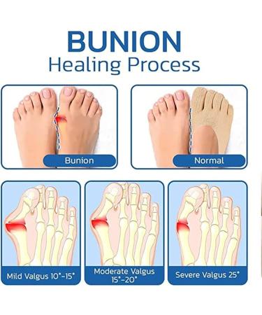 Folenzu Bunion Relief Socks - 5pcs Set for Orthoes & Projoint Antibunions - Grey Compression Toe Socks - Buy Online on GoSupps.com