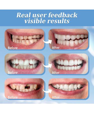 2 Pairs Temporarily Adjustable for Men and Women Regain Confidence Smile(White) - Buy Online on GoSupps.com