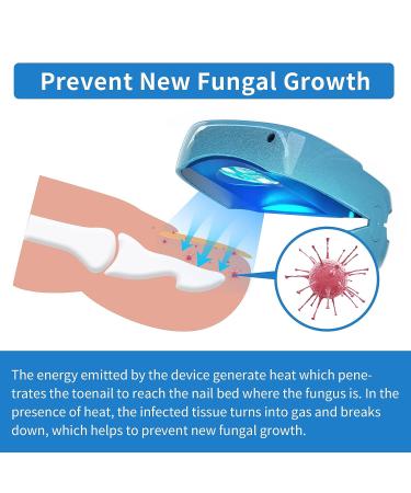 Nail Fungus Laser Treatment Device - Blue Light Therapy for Onychomycosis - Home Use for Toenail and Fingernail Treatment - Buy Online on GoSupps.com