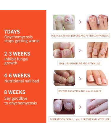 Extra Strength Toenail Fungus Treatment - 32 Pcs Nighttime Renewal Patch for Fast Relief & Visible Results - Buy Online on GoSupps.com