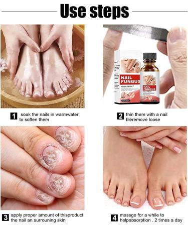 Tlopa Nail Growth And Strengthening Serum Nail Growth and Strength Serum Toenail Growth Treatment for Damaged Nail Stronger Nails in 1 Week Nail Strengthening Treatment (3PC) - Buy Online on GoSupps.com