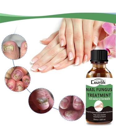 Nail Fungus Treatment for Toenail Extra Strong Nail Fungus Treatment for Toenail and Fingernail Anti fungus Nail Repair and Strengthen Fix & Renew Damaged Broken Nails (30ml) - Buy Online on GoSupps.com
