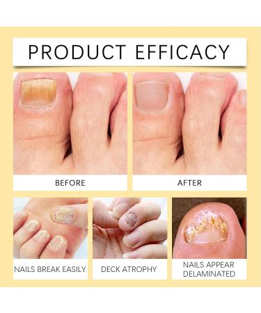 Strengthening Nail Oil | Natural Strengthening Nail Oil 100ml - Cuticle Care Toenail Repair Liquid Regeneration System for Fragile and Brittle Nails - Buy Online on GoSupps.com