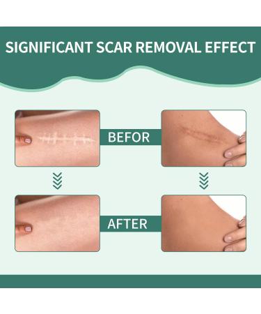 Medical Grade Silicone Scar Sheets (1.57 x 60) - Effective Scar Removal Strips for Acne & Burn Scars - Buy Online on GoSupps.com