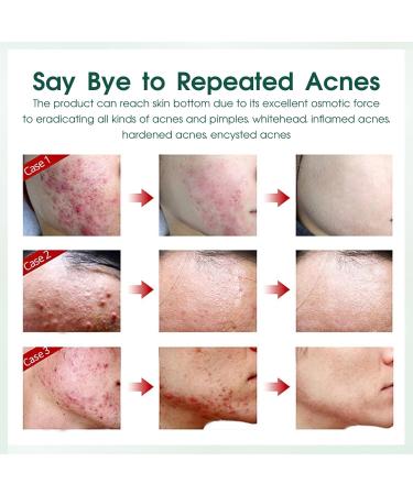 Anti Acne Face Cream Tea Tree Acne Cream for Acne Treatment & Spot Treatment Spot Cream Soothing Ance Gel for Blemishes Blackhead Remover Acne Moisturiser Reduces Redness Oil Control - Buy Online on GoSupps.com
