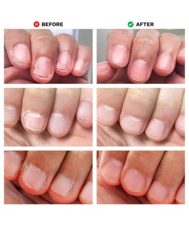 LONDONTOWN No Bite Nail Recovery - 0.40 Fl Oz. - Buy Online on GoSupps.com