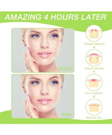 120 Pack Mandabloom Acne Pimple Patches with Tea Tree Oil & Salicylic Acid - Hydrocolloid Acne Dots for Face Zits & Breakouts - Buy Online on GoSupps.com