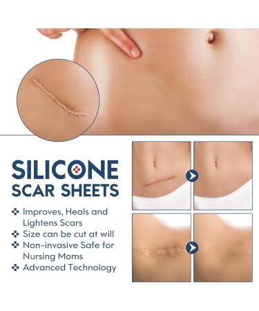 Silicone Scar Sheets(1.6"x115"-2.9M) Medical Grade Silicone Scar Tape Silicone Strips for Scar Healing Painless Scar Removal Tape for All Surgical Incisions C-Section Burn Keloid Acne 1.6"x115"-2.9M 1.6"x115"-2.9m - Buy Online on GoSupps.com