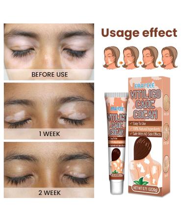 Vitiligo Care Ointment 20g | Repigmentation & Relief Cream | Improves Skin Pigmentation | Easy to Apply | 5-Pack - Buy Online on GoSupps.com