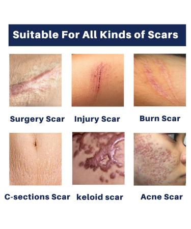 Advanced Scar Gel - Powerful Cream for Surgical, Burn, and Acne Scars - 30g - Buy Online on GoSupps.com