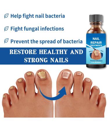 Fungal Nail Treatment 30ML Nail Fungus Serum for Toenail Extra Strong Gentle Anti Fungal Nail Serum Protects Thick Broken Discolored Nails Restoring Healthy Nails For Finger And Toe Nail Fungal - Buy Online on GoSupps.com