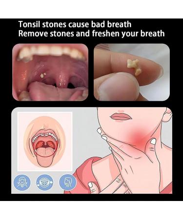 Black Tonsil Stone Removal Kit & Vacuum - Manual Tool for Adults - Buy Online on GoSupps.com