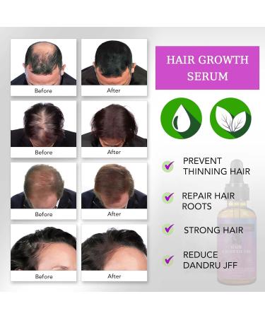 Trendyfave Hair Growth Serum Vitamins Serum for Hair Loss and Hair Regrowth Ginger Oil for Hair Growth for Balding Thinning Repairs Hair Follicles Natural Herbal Hair Growth Oils for Men and Women - Buy Online on GoSupps.com