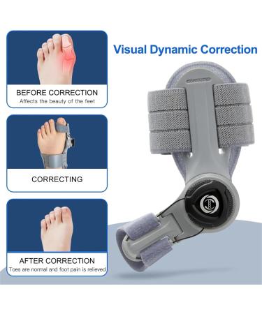 Zeetan Adjustable 2-Piece Toe Corrector - Relief for Bunions & Orthopedic Toe Smoothing with Heel Straps | International Shipping Available - Buy Online on GoSupps.com