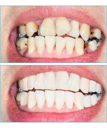 Buy Cosmetic Dentures - Temporary False Teeth Set for Men & Women | Dental Cover Top & Bottom | 2 Pairs - Buy Online on GoSupps.com