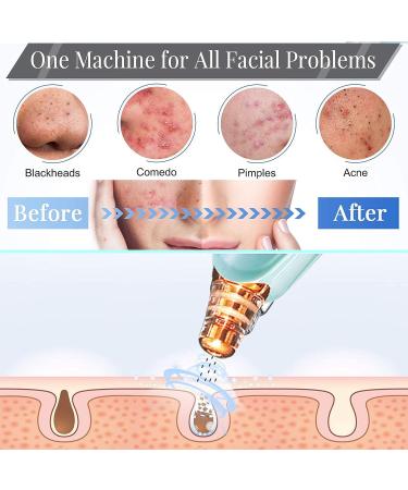 Blackhead Remover Pore Vacuum Cleaner - Electric USB Facial Pore Cleaner with 5 Probes - Upgraded Blackhead Suction Tool Kit (Green) - Buy Online on GoSupps.com